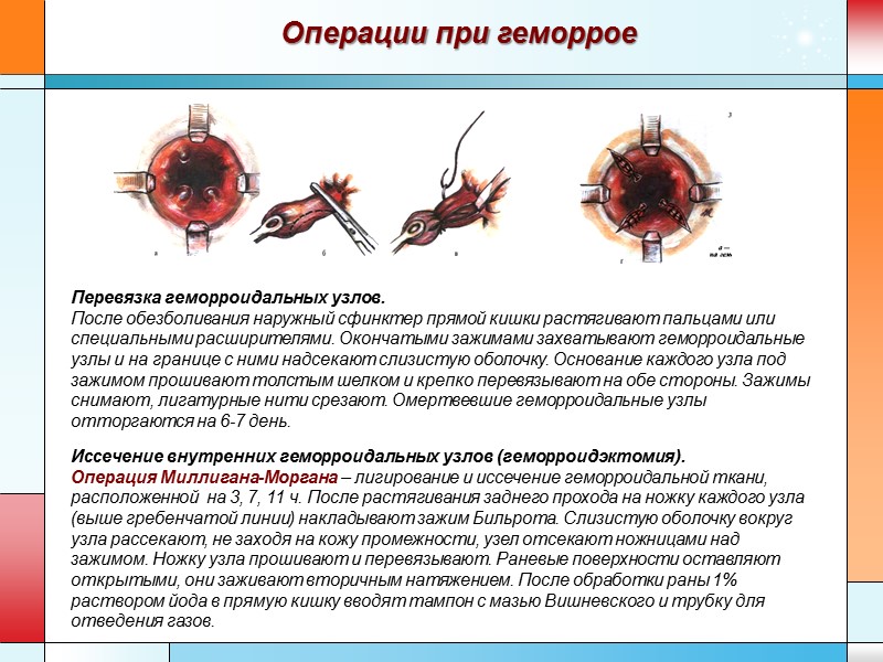 Операции при геморрое Перевязка геморроидальных узлов.  После обезболивания наружный сфинктер прямой кишки растягивают